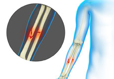 Adult Forearm Fractures