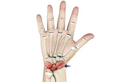 Arthritis of the Hand and Wrist