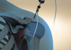 Arthroscopic Acromioplasty