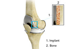 Cementless Total Knee Arthroplasty