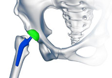 Custom/Patient-Specific Hip Replacement