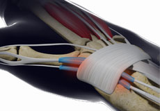 DeQuervain’s Tendonitis