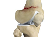 Distal Femur Fracture