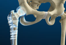 Hip Fracture ORIF