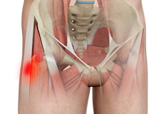 Hip Tendonitis