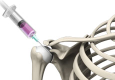 Intraarticular Shoulder Injection