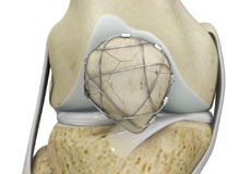 ORIF of the Knee Fracture