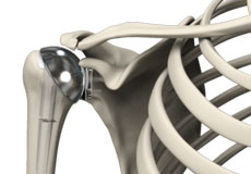 Outpatient Shoulder Replacement