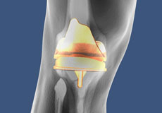 Patient Specific Knee Replacement