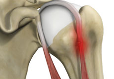 Proximal Biceps Tendinitis