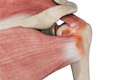 Rotator Cuff Arthropathy