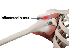 Rotator Cuff Bursitis