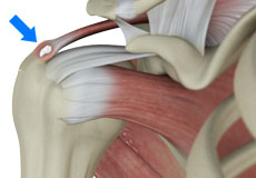 Rotator Cuff Calcification