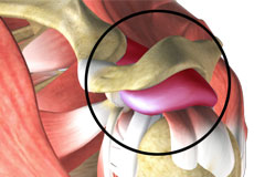 Shoulder Bursitis