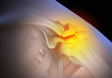 Shoulder Impingement