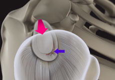 Shoulder Labral Tear