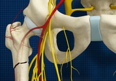 Subtrochanteric Hip Fracture