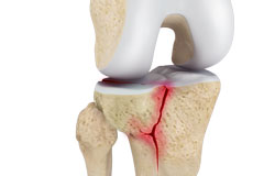 Tibial Plateau Fracture