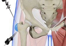 Trochanteric Bursectomy