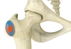 Trochanteric Bursitis