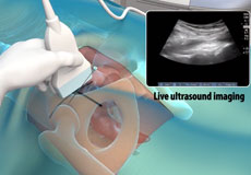 Ultrasound Guided Hip Injections