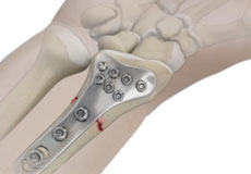 Wrist Open Reduction and Internal Fixation